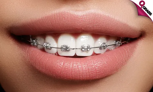 Metal Dental Braces!